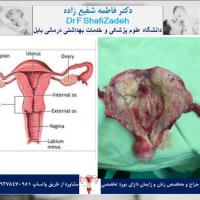 عمل هیسترکتومی در یک خانم ۴۸ساله مولتی پار 1 عمل هیسترکتومی در یک خانم ۴۸ساله مولتی پار 1