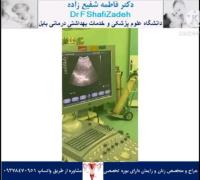 احتباس جفت 1 احتباس جفت 1