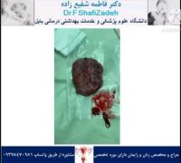 احتباس جفت 2 احتباس جفت 2