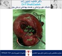 حاملگی پرخطر 2 حاملگی پرخطر 2