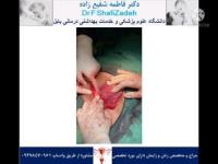چرخش رحم 1 چرخش رحم 1