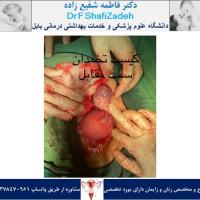 چرخش رحم 5 چرخش رحم 5