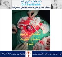 چرخش تخمدان 1 چرخش تخمدان 1