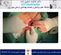 چرخش تخمدان 7 چرخش تخمدان 7