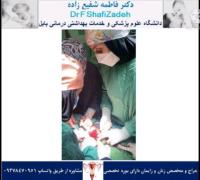 آدنومیوز رحم 4 آدنومیوز رحم 4